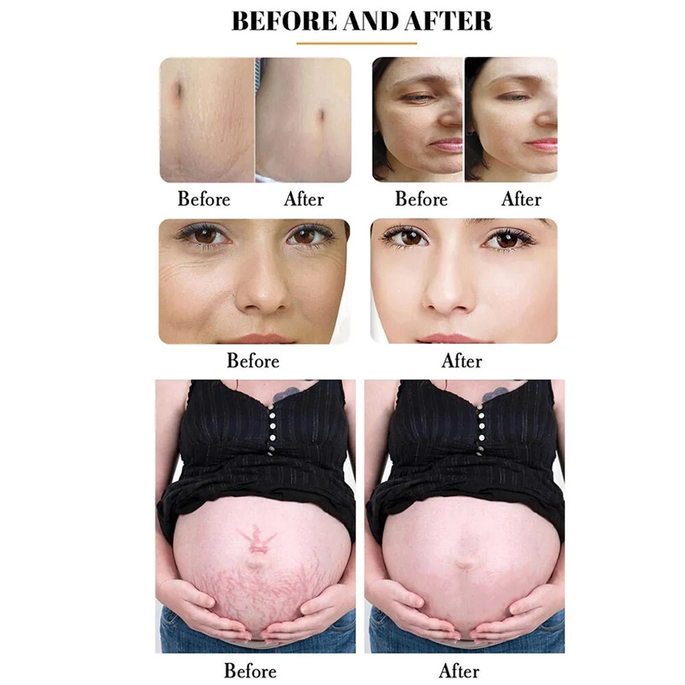 Fractional CO2 Laser Machine for Skin Resurfacing