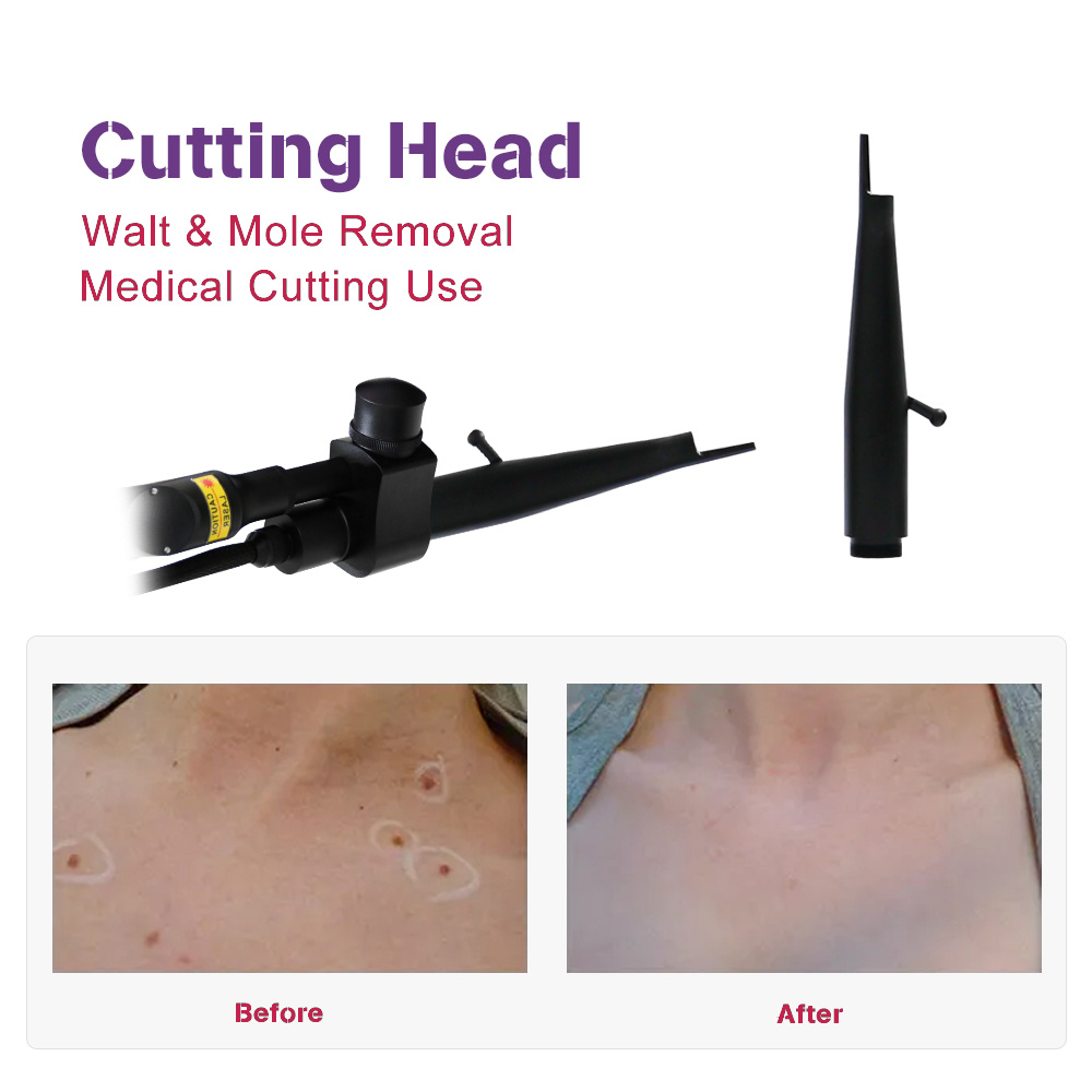 Fractional CO2 Laser Machine 60W for Skin Resurfacing