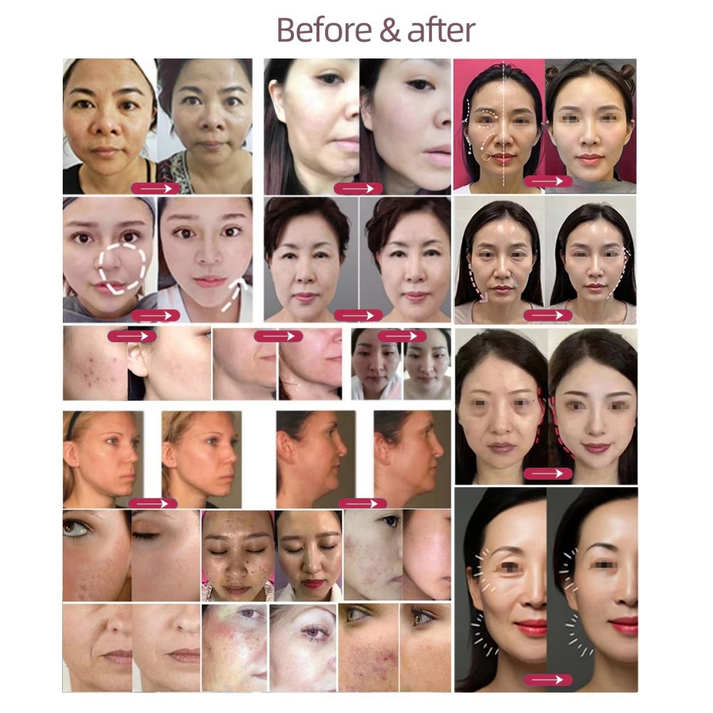 Diamond Microdermabrasion Machine for Blackhead Removal