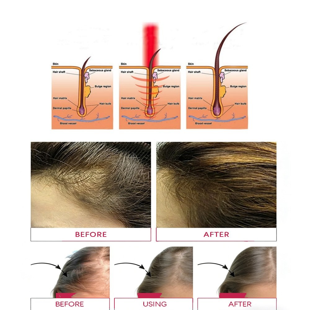 Laser Hair Growth Machine 5 in 1 Scalp Care System