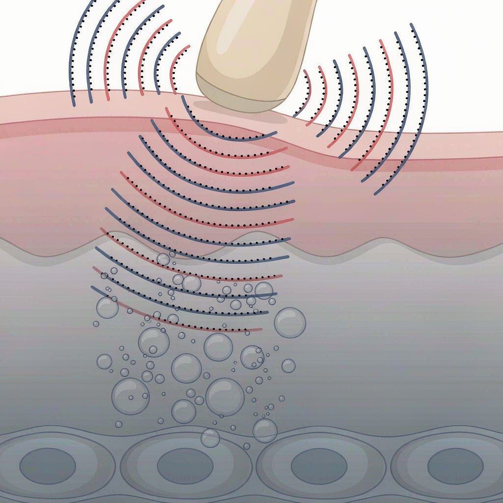 Diagram of ultrasonic cavitation sound waves creating bubbles that rupture fat cells under the skin